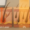 808nm Diode Laser Hair Removal: Permanent Results & Why It Dominates 2025’s At-Home Beauty Tech