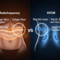 HIFEM vs. RF: The Ultimate 2025 Guide to Body Contouring—Skin Tightening or Muscle Building?